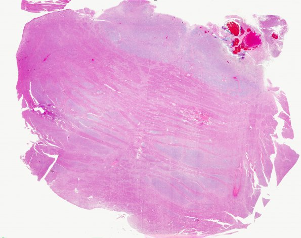 12C1 Cavernoma, multiple, familial (Case 12) N12 H&E WM