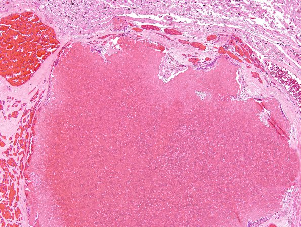 12C3 Cavernoma, multiple, familial (Case 12) N12 H&E 4