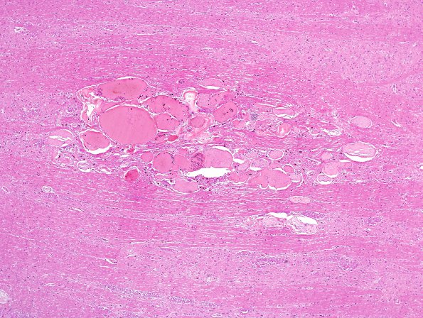 12C7 Cavernoma, multiple, familial (Case 12) N12 H&E 5