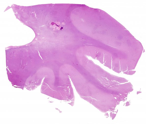 12D1 Cavernoma, multiple, familial (Case 12) N15 H&E  WM