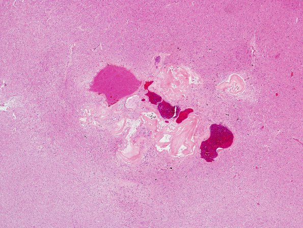 12D2 Cavernoma, multiple, familial (Case 12) N15 H&E 12