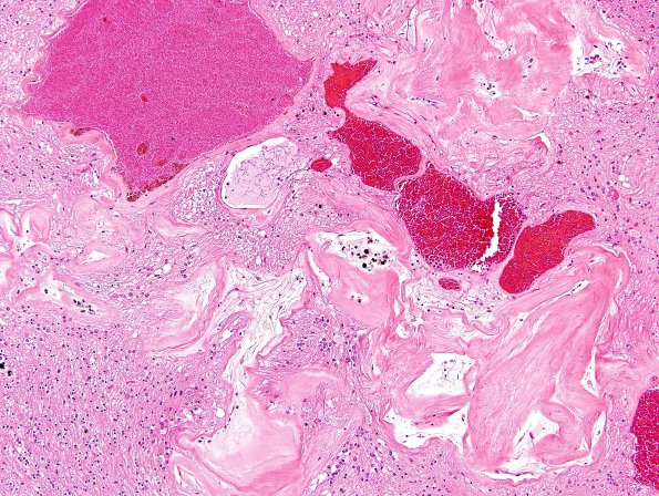 12D3 Cavernoma, multiple, familial (Case 12) N15 H&E 11