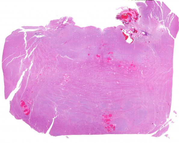 12E1 Cavernoma, multiple, familial (Case 12) N13 H&E WM