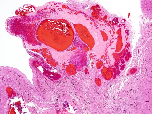 12E2 Cavernoma, multiple, familial (Case 12) N13 H&E 2