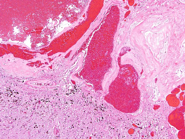 12E3 Cavernoma, multiple, familial (Case 12) N15 H&E 2