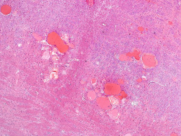 12E4 Cavernoma, multiple, familial (Case 12) N13 H&E 4