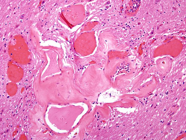 12E5 Cavernoma, multiple, familial (Case 12) N13 H&E 6