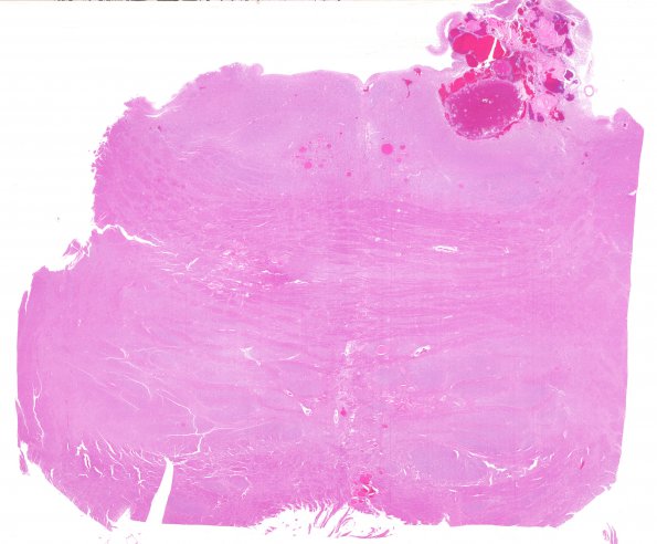 12F1 Cavernous Malformations, multiple, familial (Case 12) N17 H&E whole mount