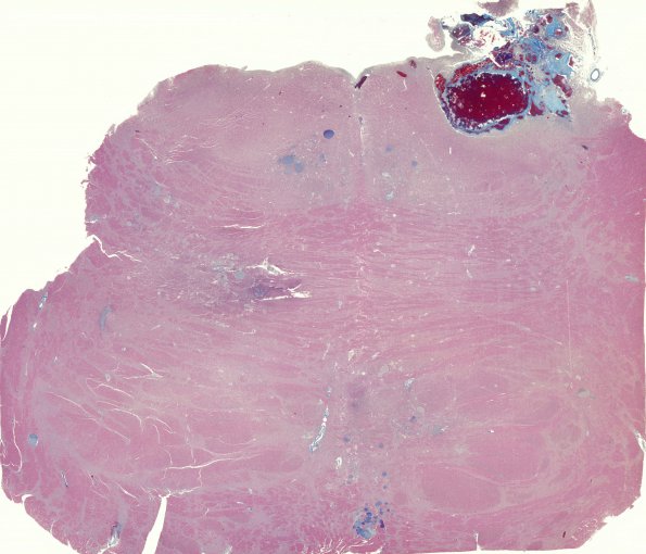 12F3 Cavernoma, multiple, familial (Case 12) N17 Trichrome WM