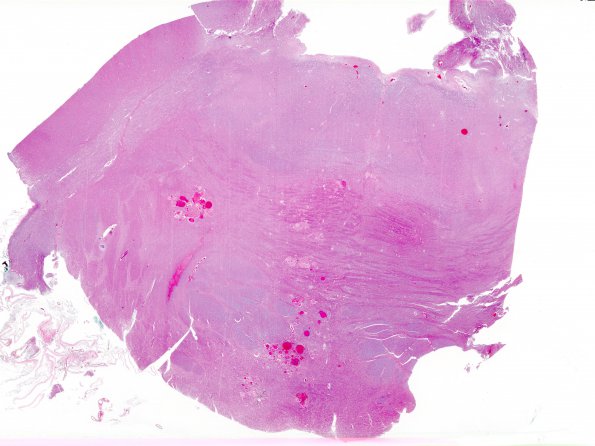 12G1 Cavernous Malformations, multiple, familial (Case 12) N18 H&E whole mount