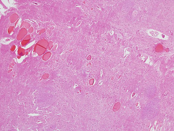 12G2 Cavernoma, multiple, familial (Case 12) N18 H&E 1