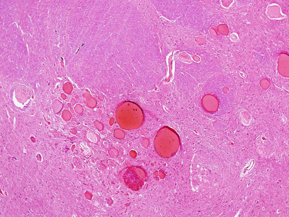 12G3 Cavernous Malformations, multiple, familial (Case 12) N18 H&E 3