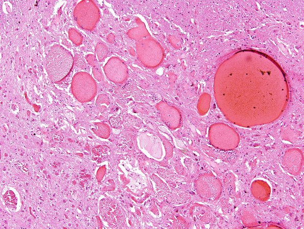 12G4 Cavernous Malformations, multiple, familial (Case 12) N18 H&E 2