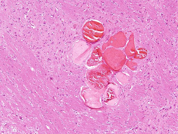 12G5 Cavernous Malformations, multiple, familial (Case 12) N18 H&E 1