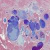 12G7 Cavernoma, multiple, familial (Case 12) N18 Trichrome 3