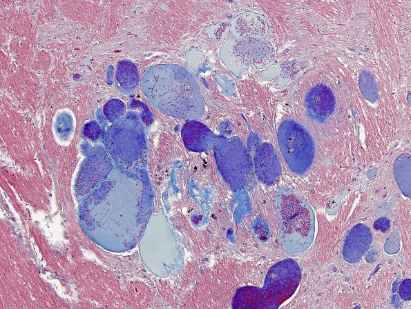 12G7 Cavernoma, multiple, familial (Case 12) N18 Trichrome 3