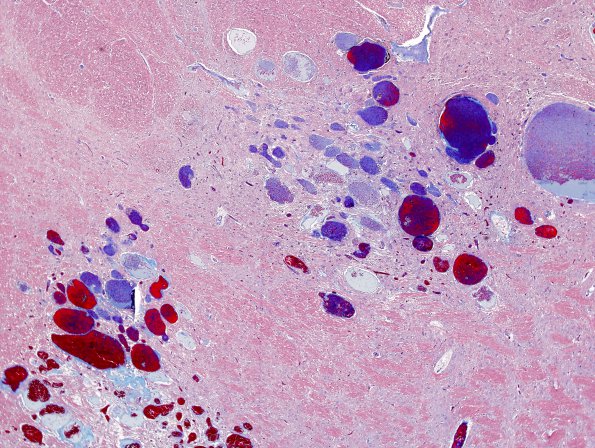 12G8 Cavernoma, multiple, familial (Case 12) N18 Trichrome 3