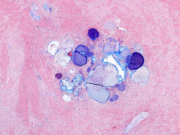 12G9 Cavernoma, multiple, familial (Case 12) N18 Trichrome 7