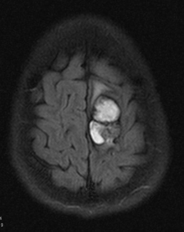 13A1 Cavernomas (Case 13) FLAIR 1 - Copy