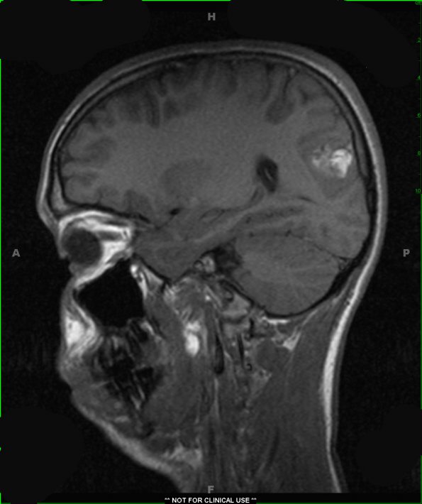 13A2 Cavernomas (Case 13) T1 2 - Copy