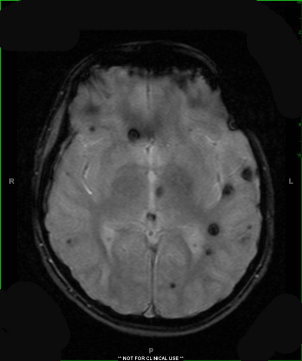 13A4 Cavernomas (Case 13) T2 FL2D AX Hemo 2 - Copy