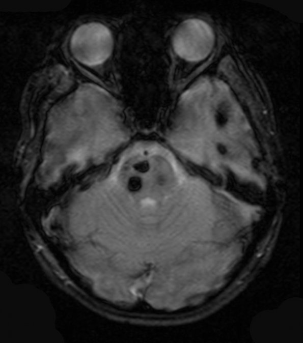 13A5 Cavernomas (Case 13) T2 FL2D AX Hemo 3 - Copy