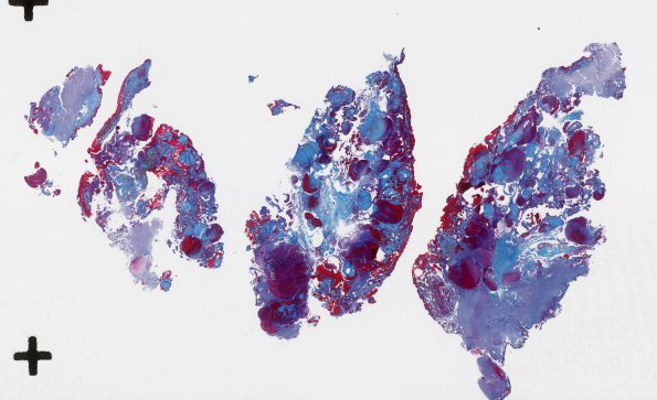 13C1 Cavernomas (Case 13) Trichrome whole mount