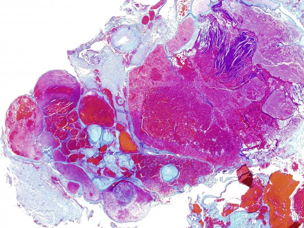 13C2 Cavernomas (Case 13) Trichrome 3