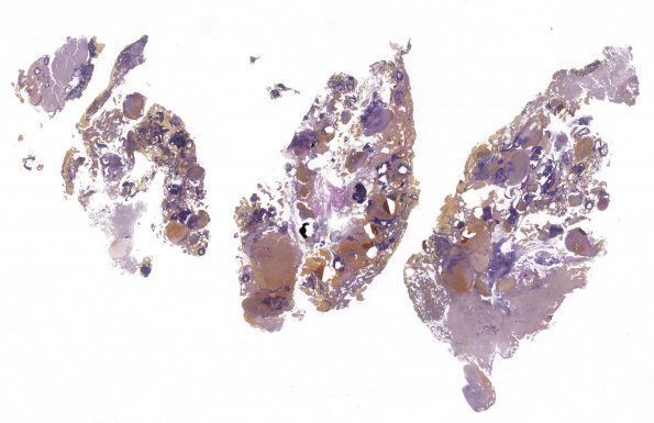 13D1 Cavernomas (Case 13) Elastin