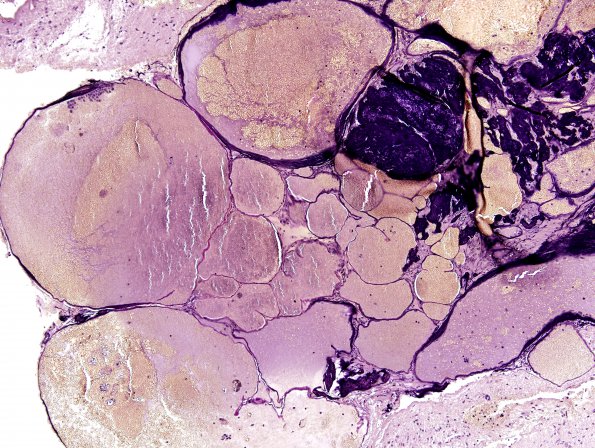 13D2 Cavernomas (Case 13) Elastin 1