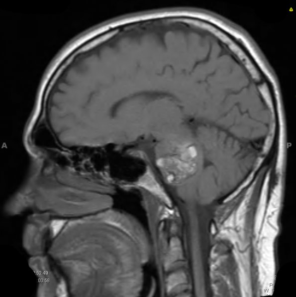 14A1 Cavernous Hemangioma, Pons (Case 14) T1 1 - Copy