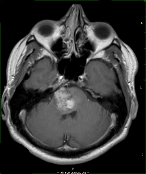 14A2 Cavernous Hemangioma, Pons (Case 14) T1 W 1 - Copy