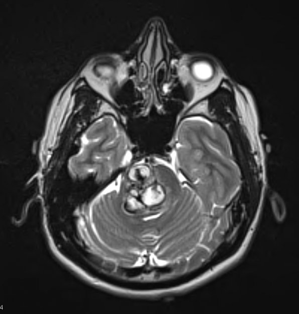 14A3 Cavernous Hemangioma, Pons (Case 14) T2 W 2 - Copy