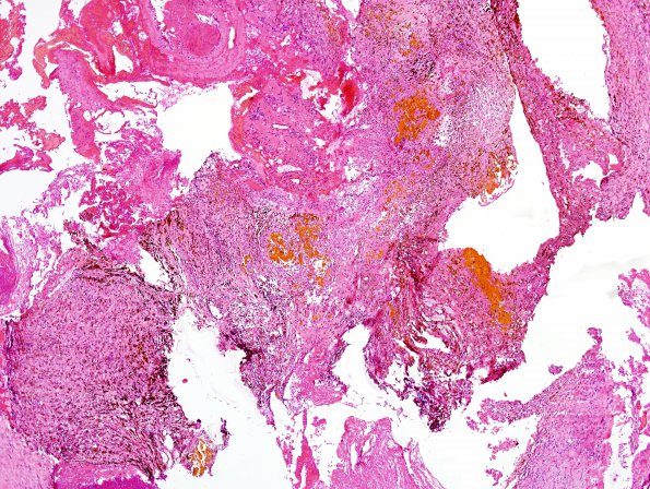 14B2 Cavernoma, Pons (Case 14) Hemosid vs hematoid H&E 2