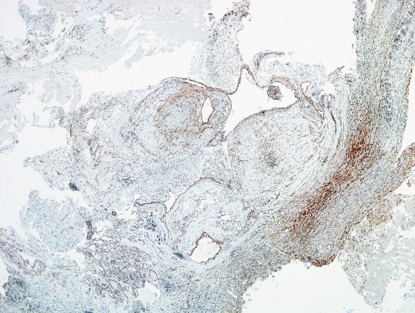 14D Cavernous Hemangioma, Pons (Case 14) SMA