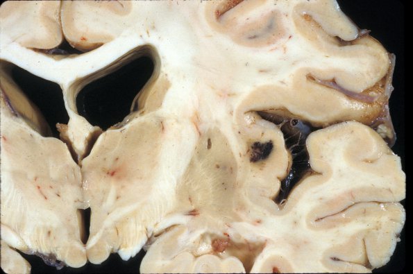 15A1 Cavernous Angioma (Case 15) 2