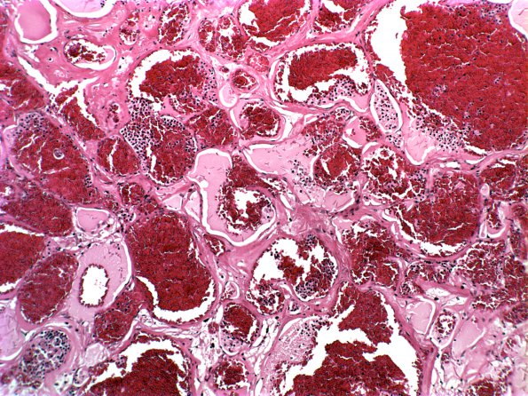 15B2 Cavernous Angioma (Case 15) 4