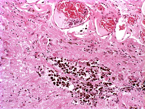 15B3 Cavernous Angioma (Case 15) 3