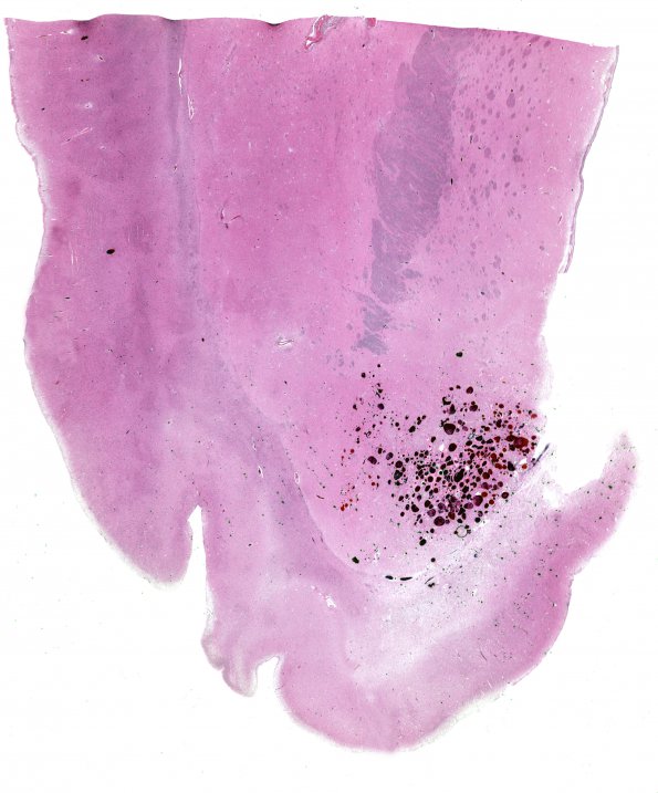 16A1 Cavernous Angioma (Case 16) H&E WM