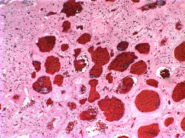 16A2 Cavernous Angioma (Case 16) H&E 1