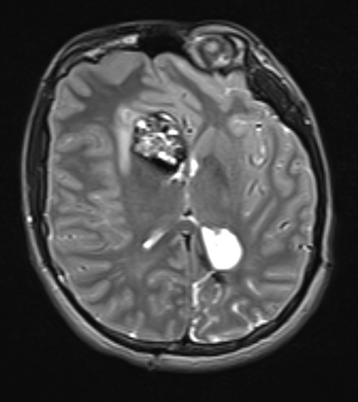 17A1 Cavernous Angioma (Case 17) T2