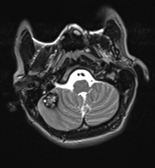 17A2 Cavernous Angioma (Case 17) T2 2