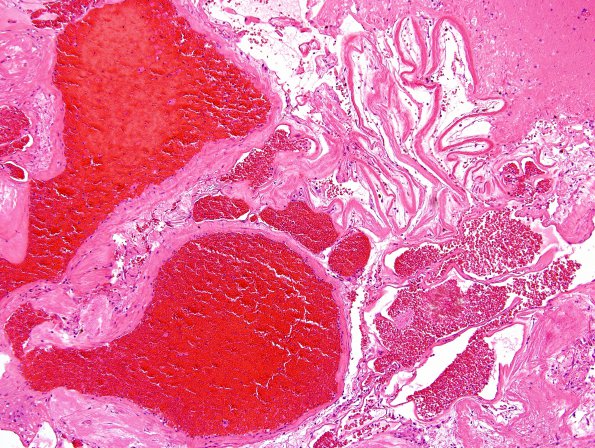 17B2  Cavernous Angioma (Case 17) H&E 7