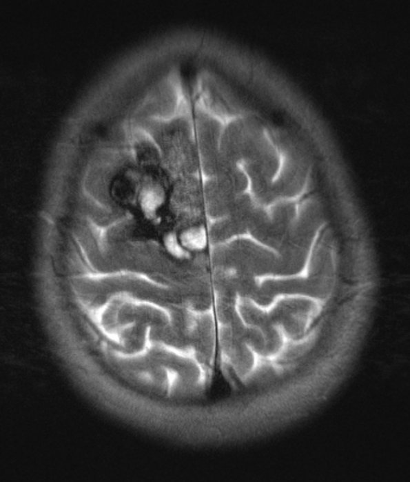 18A Cavernoma (Case 18) T2