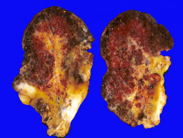 18B Cavernous Angioma (Case 18) surgical specimen