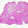 18C1 Cavernous Angioma (Case 18) H&E whole mount