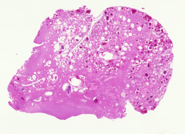 18C1 Cavernous Angioma (Case 18) H&E whole mount