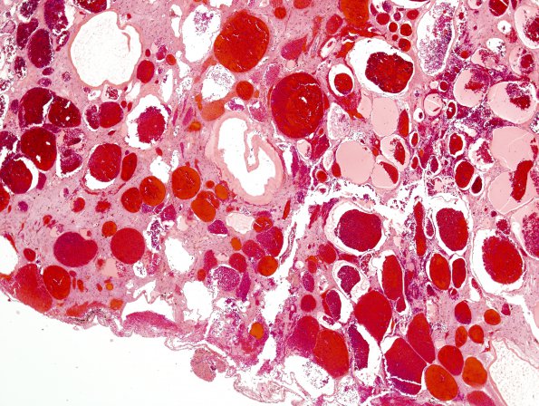18C2 Cavernous Angioma (Case 18) 9