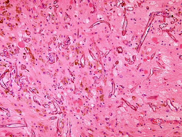 18C4 Cavernous Angioma (Case 18) 12