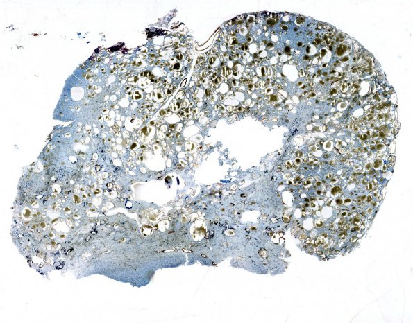 18E1 Cavernous Angioma (Case 18) SMA 1